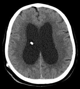 Fig. 1 - TC encefalo post-operatoria. In bianco è visibile il catetere ventricolare.